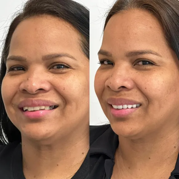 PROTOCOLO CARGA IMEDIATA